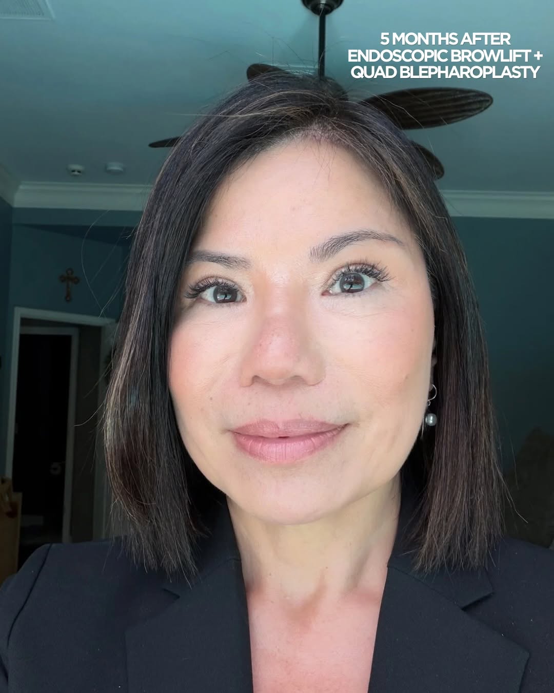 Instagram post by Dr. Sanaz Harirchian: 5 months post-op β¨ Beautiful, refreshed results after an Endoscopic Brow Lift + Quad Blepharoplasty. Her eyes look brighter and more open whβ¦