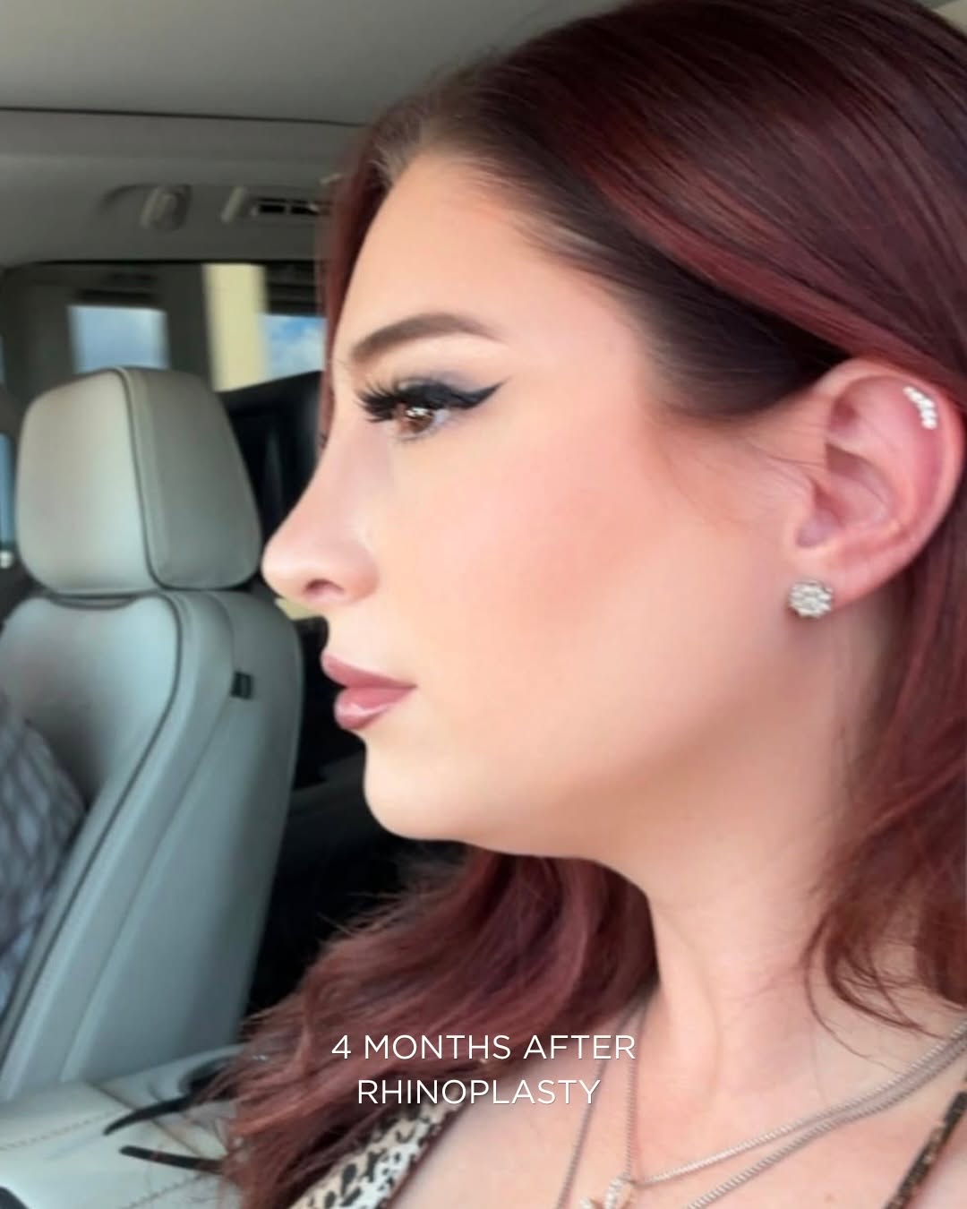 Instagram post by Dr. Sanaz Harirchian: 4 months after Rhinoplasty β¨ ππ€ π¨ππ π’π ππ¨ π π₯ππ©πππ£π©, π₯π‘πππ¨π ππ€π£π©πππ© π€πͺπ§ ππ€πͺπ¨π©π€π£ π€π§ ππ€π€ππ‘ππ£οΏ½β¦