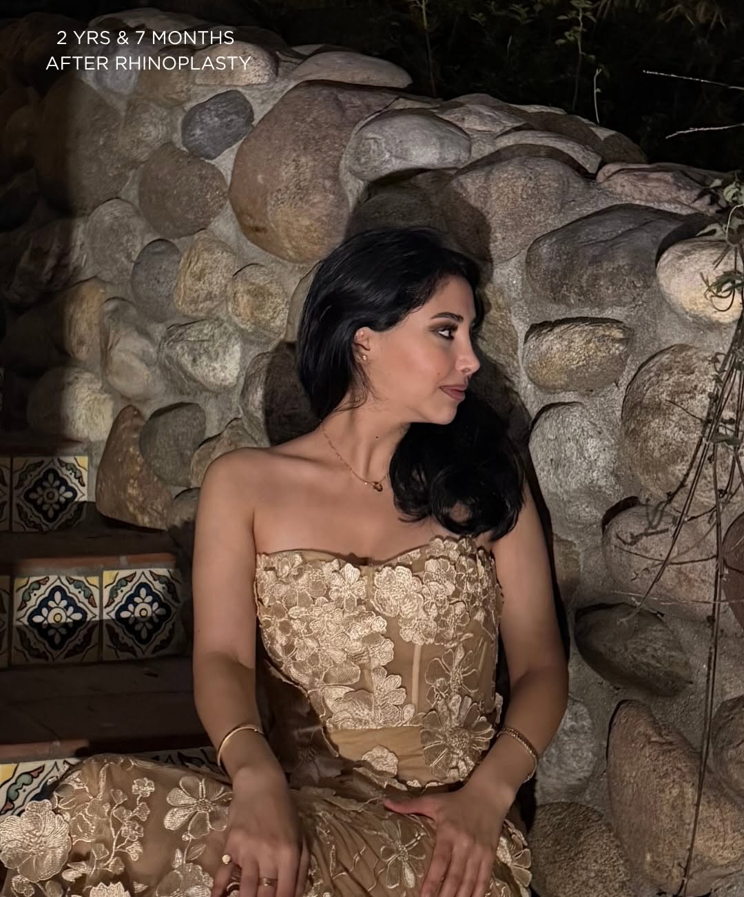 Instagram post by Dr. Sanaz Harirchian: 2 years & 7 months after Rhinoplasty π€© Love to show how rhinoplasties settle as the years go by! ππ€ π¨ππ π’π ππ¨ π π₯ππ©πππ£π©, οΏ½β¦