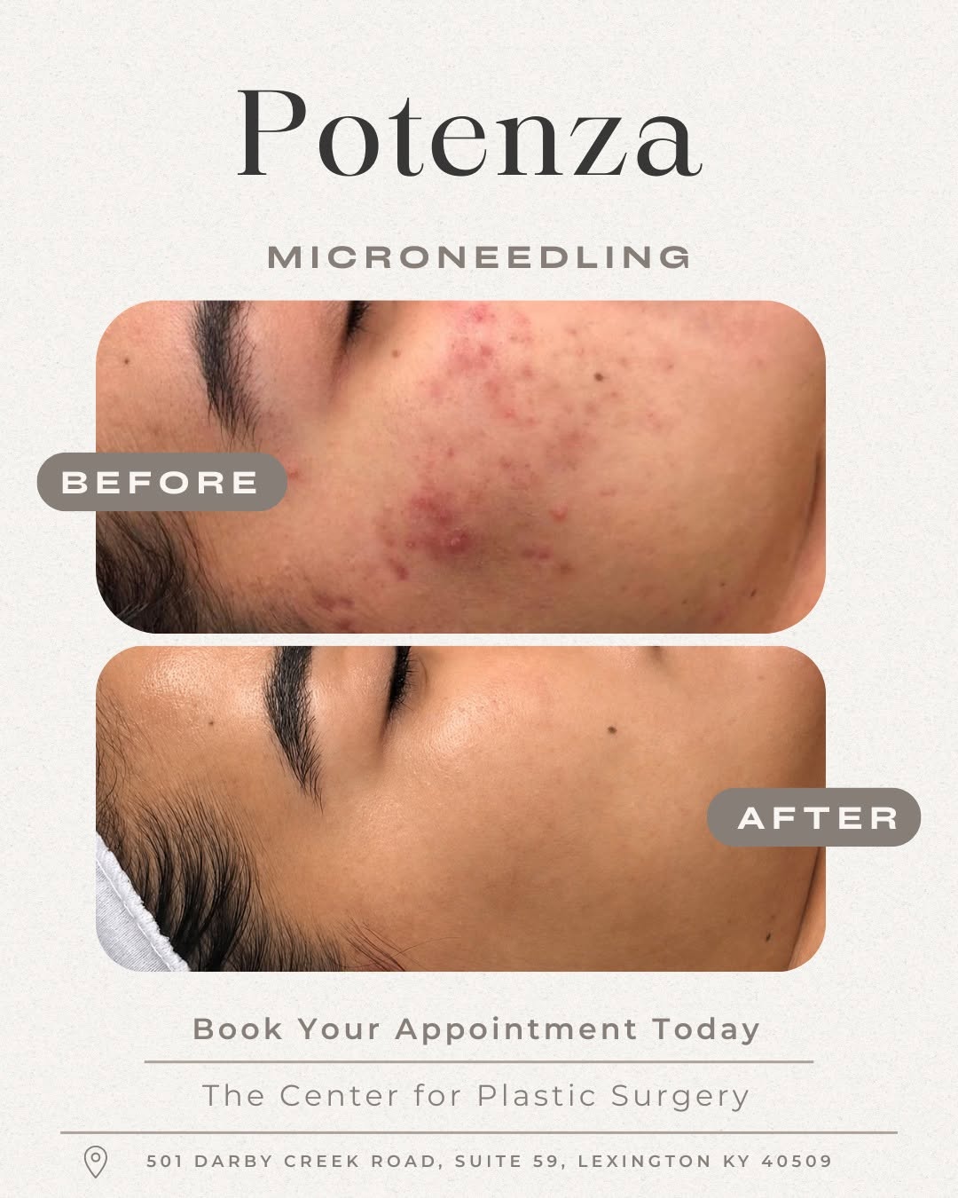 Instagram post by Dr. Sandra Bouzaglou: ✨ Reveal smoother, brighter, more youthful-looking skin with Potenza™ RF Microneedling! ✨ Potenza combines the power of microneedling with r…