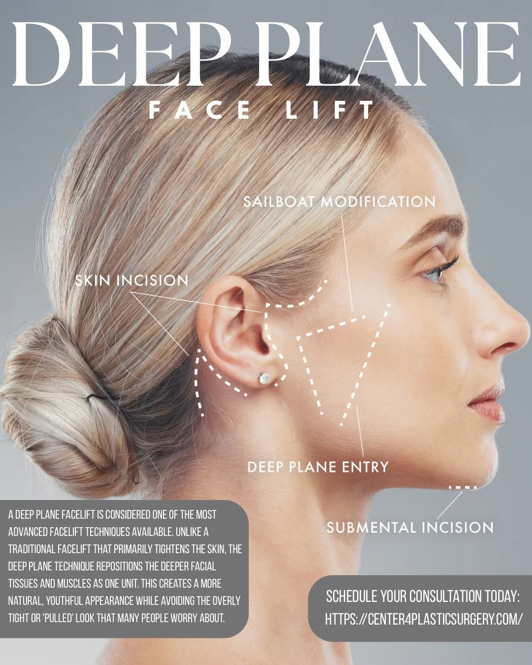 Instagram post by Dr. Sandra Bouzaglou: ✨The Facelift Everyone Wants-But No One Can Tell You Had.✨ 💖The most beautiful facelift is the one that doesn’t look like a facelift at all…