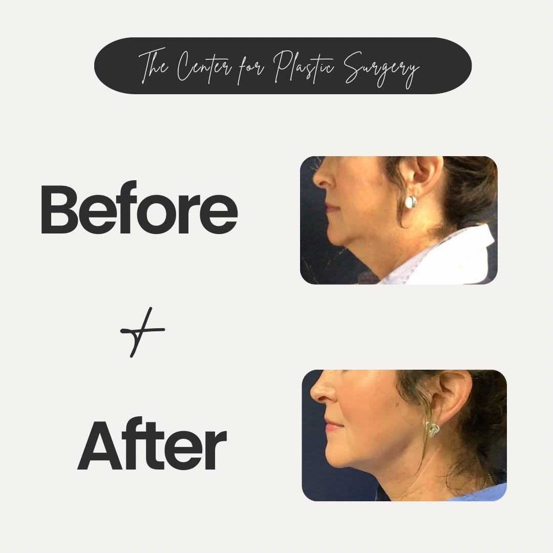 Instagram post by Dr. Sandra Bouzaglou: A beautifully refreshed profile starts here. ✨ Our patient’s neck lift delivered a smoother, more defined neckline and a rejuvenated appeara…