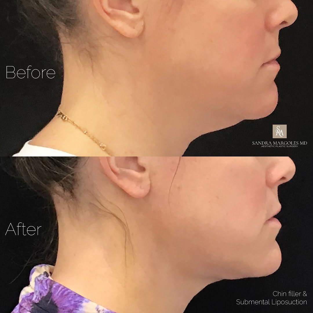 Instagram post by Dr. Sandra L. Margoles: From undefined to ultra-defined! ✨ This stunning transformation was achieved with submental liposuction and chin filler, creating a sculpted…