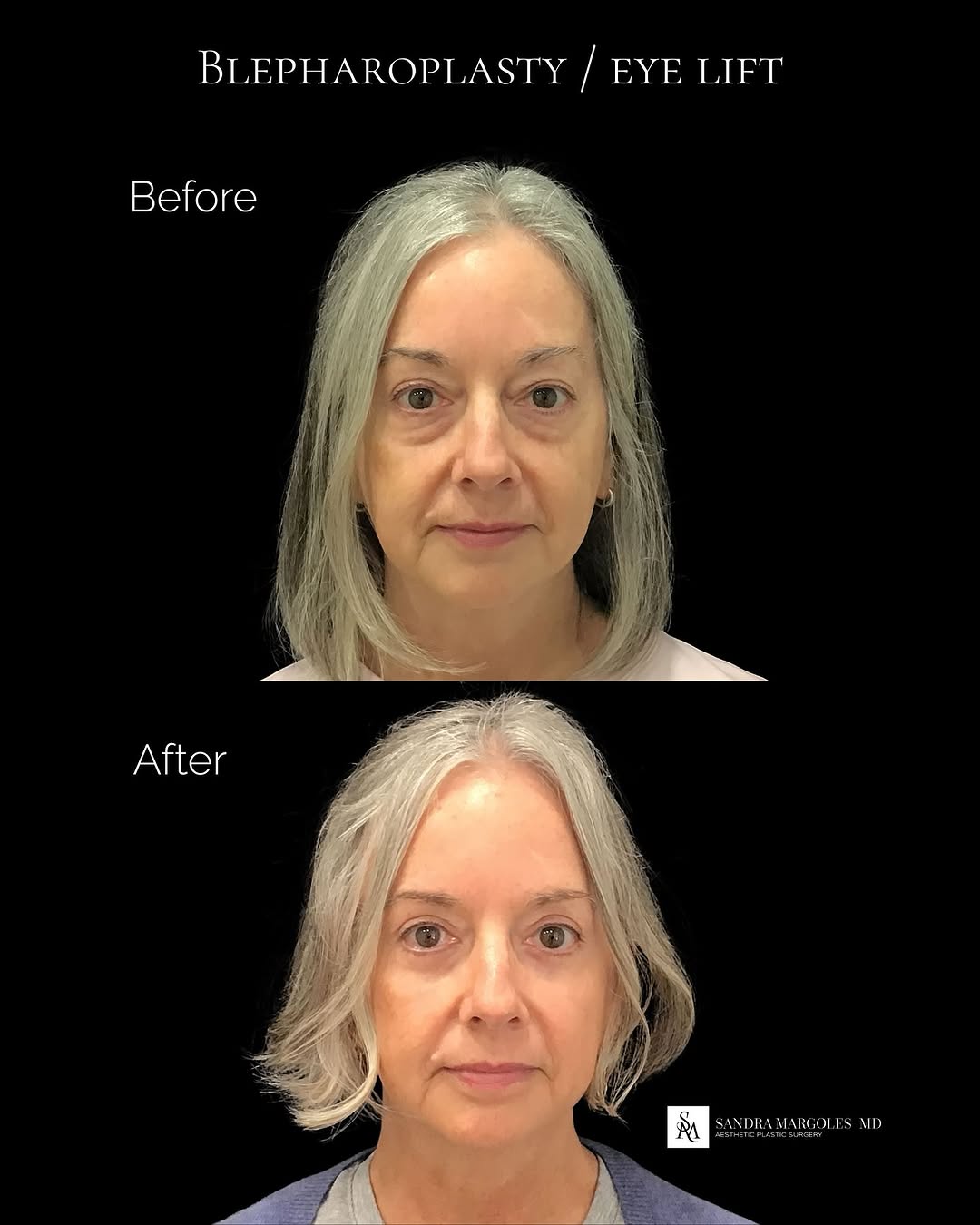 Instagram post by Dr. Sandra L. Margoles: ✨ Amazing Transformation Alert! ✨ Our patient is loving her beautiful results after blepharoplasty – a procedure that removes extra skin and…