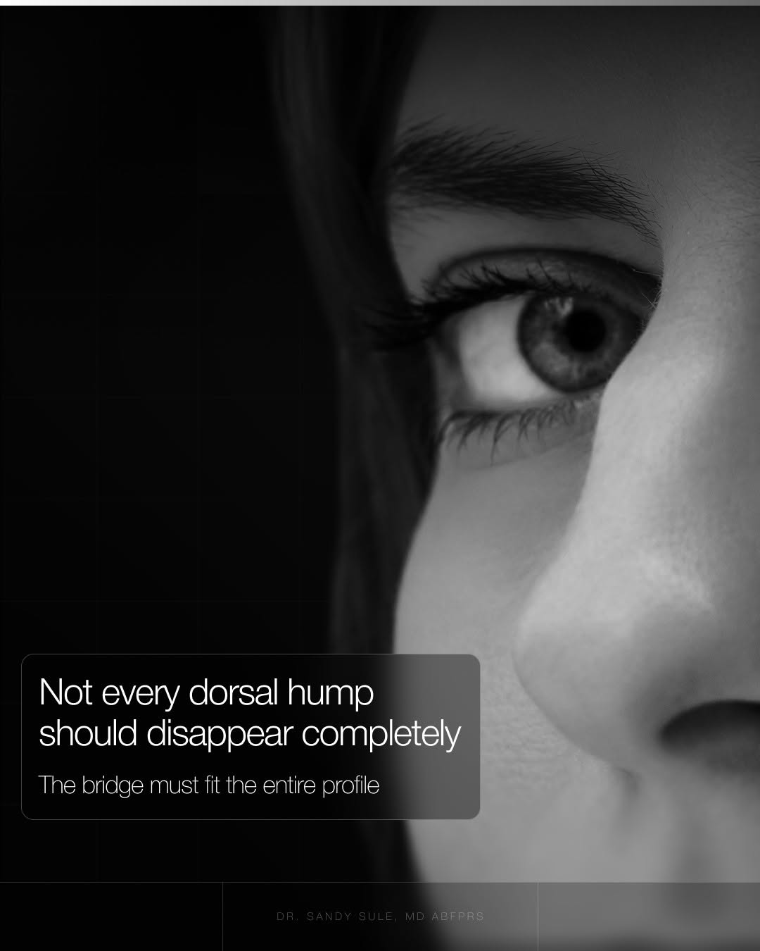 Instagram post by Dr. Sandy Sule: A dorsal hump is one of the most common concerns patients bring to a Rhinoplasty consultation. Many assume that removing it completely will …