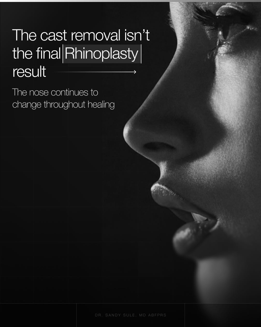 Instagram post by Dr. Sandy Sule: Cast removal is an exciting milestone, but it’s far too early to judge the final Rhinoplasty result. At that stage, swelling can still affec…
