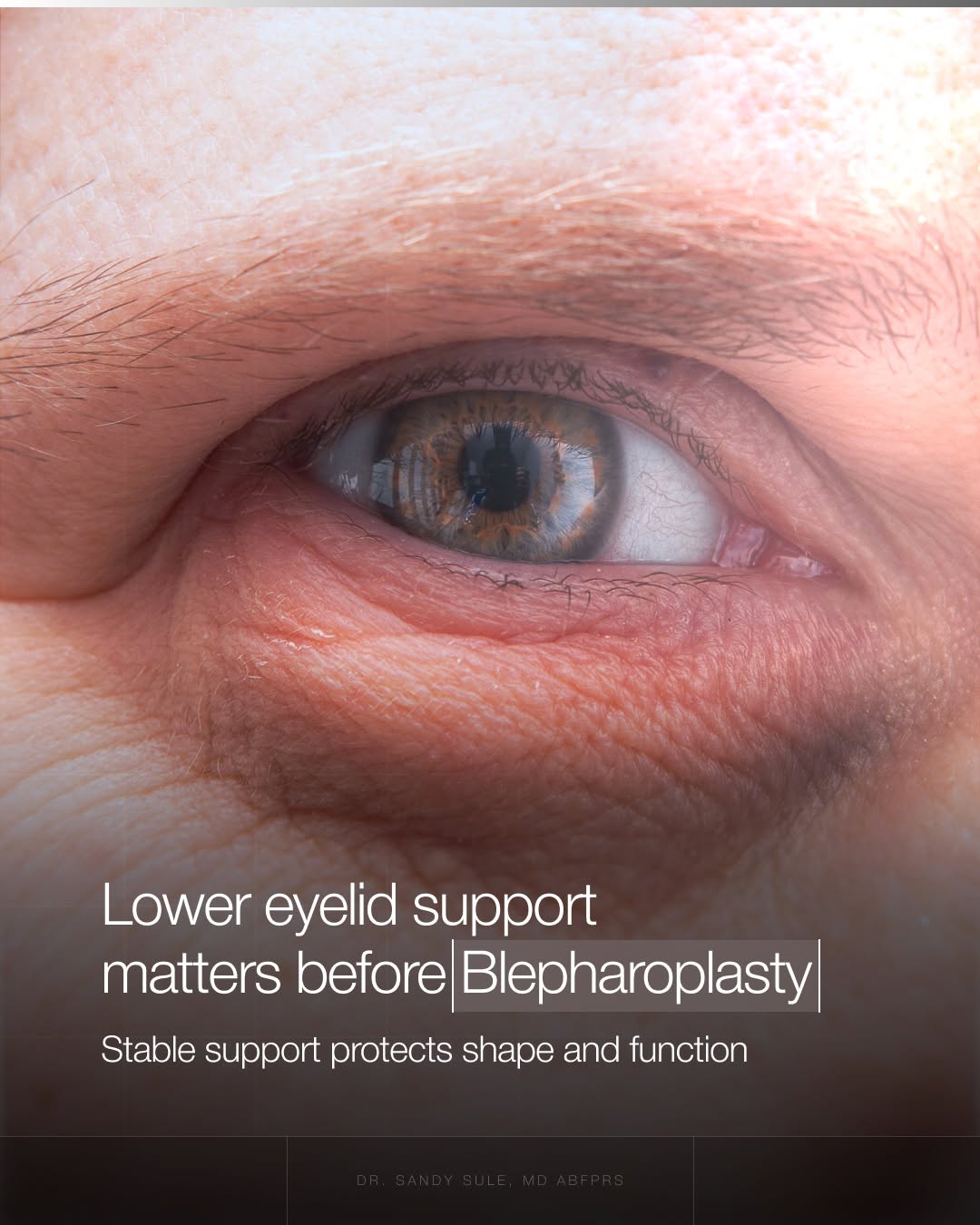 Instagram post by Dr. Sandy Sule: Before performing Lower Blepharoplasty, I evaluate how securely the eyelid rests against the eye. This tells me whether the existing support…