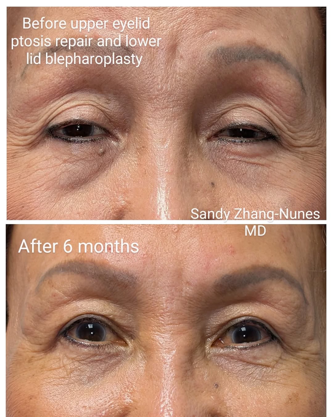 Instagram post by Dr. Sandy Zhang-Nunes: This patient was super happy with her surgery and wanted me to share. "I see better, look better and feel better!". That's my motto for all …