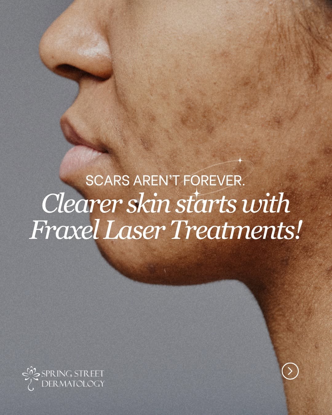 Instagram post by Dr. Sapna Palep: Acne scars don’t have to be permanent. ✨ Fraxel laser treatments can help improve skin texture and support smoother clearer skin over time. …
