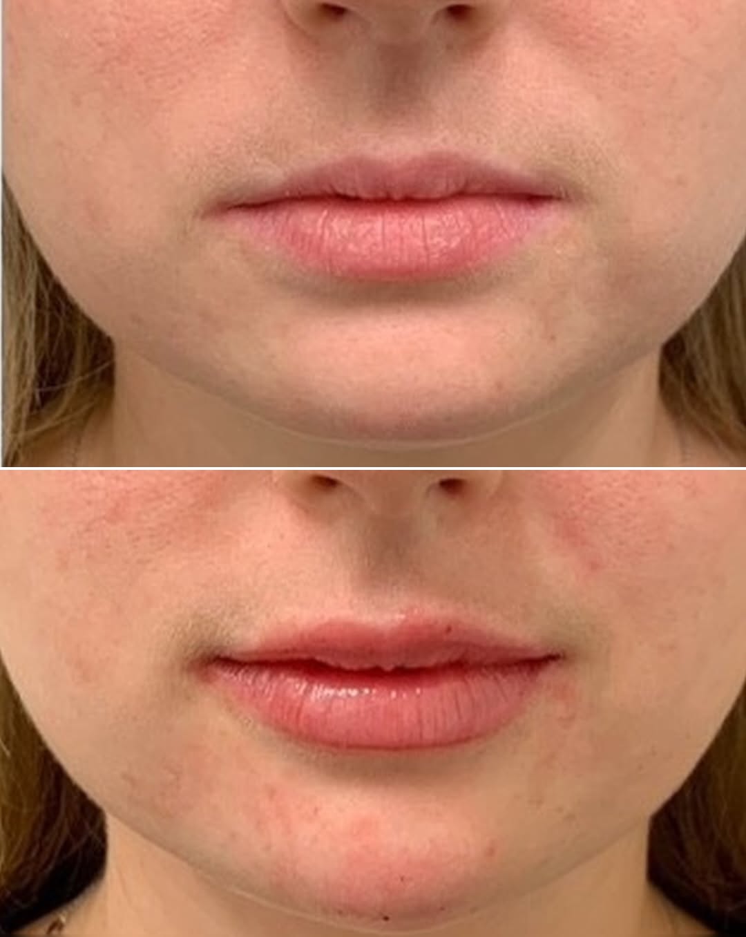 Instagram post by Dr. Sarah C. Jackson: Subtle can still be stunning ✨ Dr. Jackson used one syringe of Restylane Kysse for the lips + one syringe of Juvederm Voluma for the chin — …