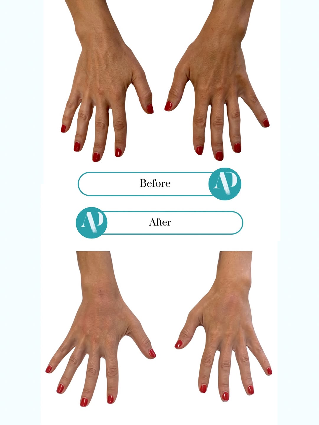 Instagram post by Dr. Sarah C. Jackson: Why do hands sometimes look older than the face? Often it comes down to volume. The soft cushion on the back of the hand thins over the year…