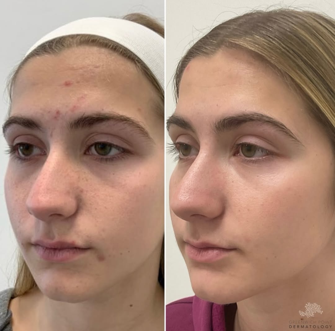 Instagram post by Dr. Sarah Dolder: Clear skin win! Dr Dolder achieved amazing results on her patient using AviClear, a breakthrough laser technology that targets acne at the s…