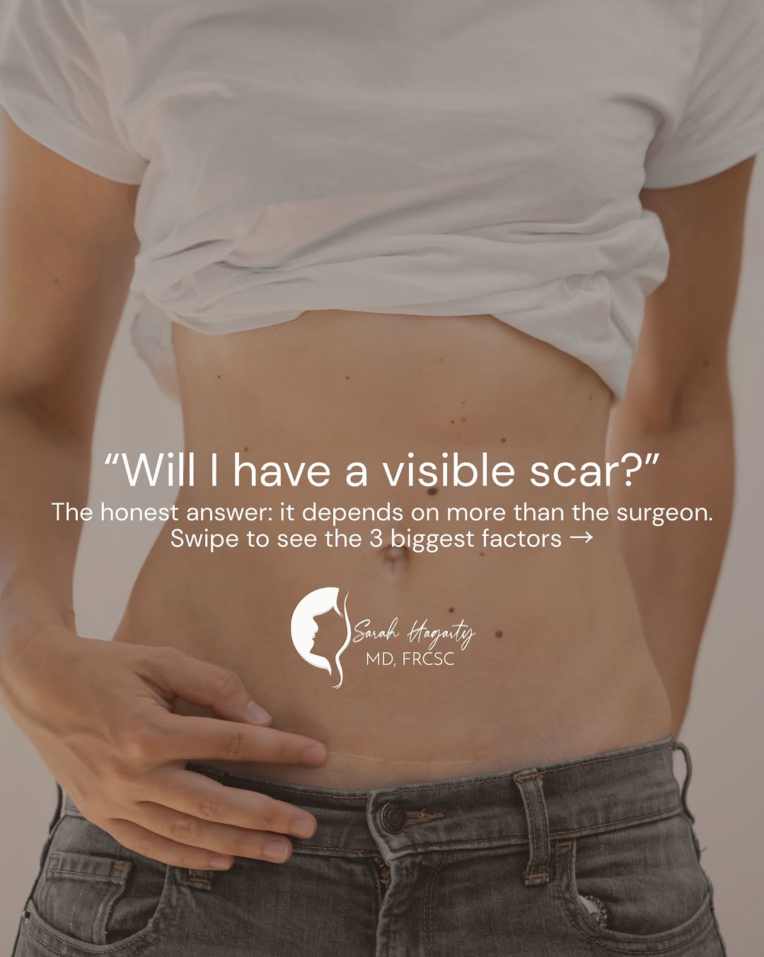 Instagram post by Dr. Sarah E. Hagarty: Curious about surgical scars? Here are three factors that may affect your healing! #PlasticSurgeryCare #RockfordPlasticSurgery #FemalePlasti…