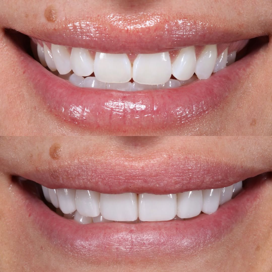 Instagram post by Dr. Sarah F. Winter, D: More presence through the entire smile, a beautiful new shape, and a result that changes the overall look without overpowering her features …