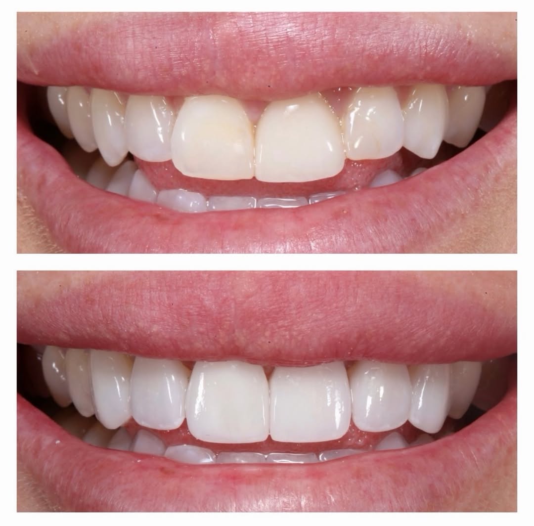 Instagram post by Dr. Sarah F. Winter, D: A smile worth showing off! From every angle, this one speaks for itself. Swipe through for the transformation and the final result outside t…