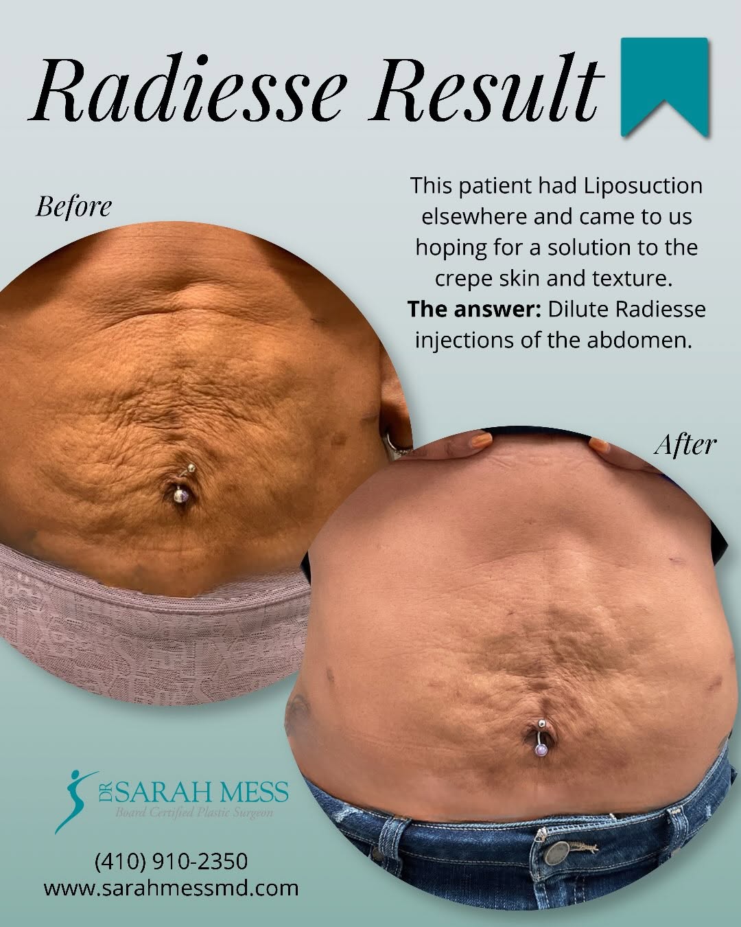 Instagram post by Dr. Sarah Mess: ✨ Collagen restoration isn’t just for the face! Radiesse® is a biostimulator that is injected beneath the surface of the skin to help stimul…
