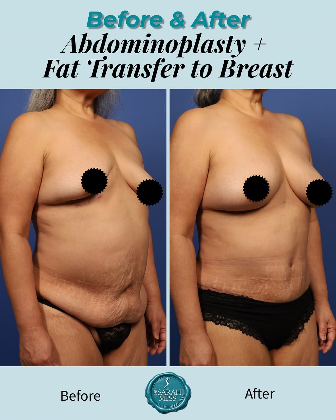 Instagram post by Dr. Sarah Mess: ✨ A transformation that is so beautifully tailored to her frame. ✨ This patient underwent fat transfer to the breasts + abdominoplasty, crea…