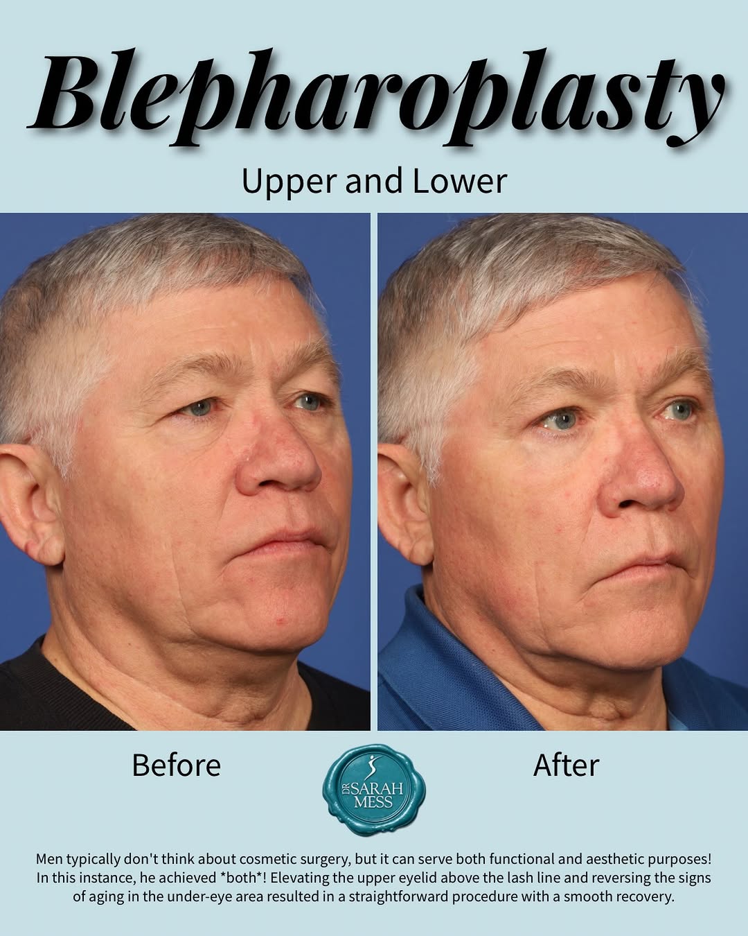 Instagram post by Dr. Sarah Mess: 👀 Looking more awake without looking different. This gentleman opted for upper and lower eyelid surgery (blepharoplasty) to refresh the app…