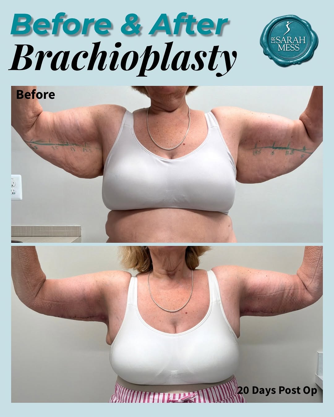 Instagram post by Dr. Sarah Mess: ✨ Just over TWO WEEKS post-op… and look at this transformation already! ✨ This brachioplasty (arm lift) result is still very early in the he…