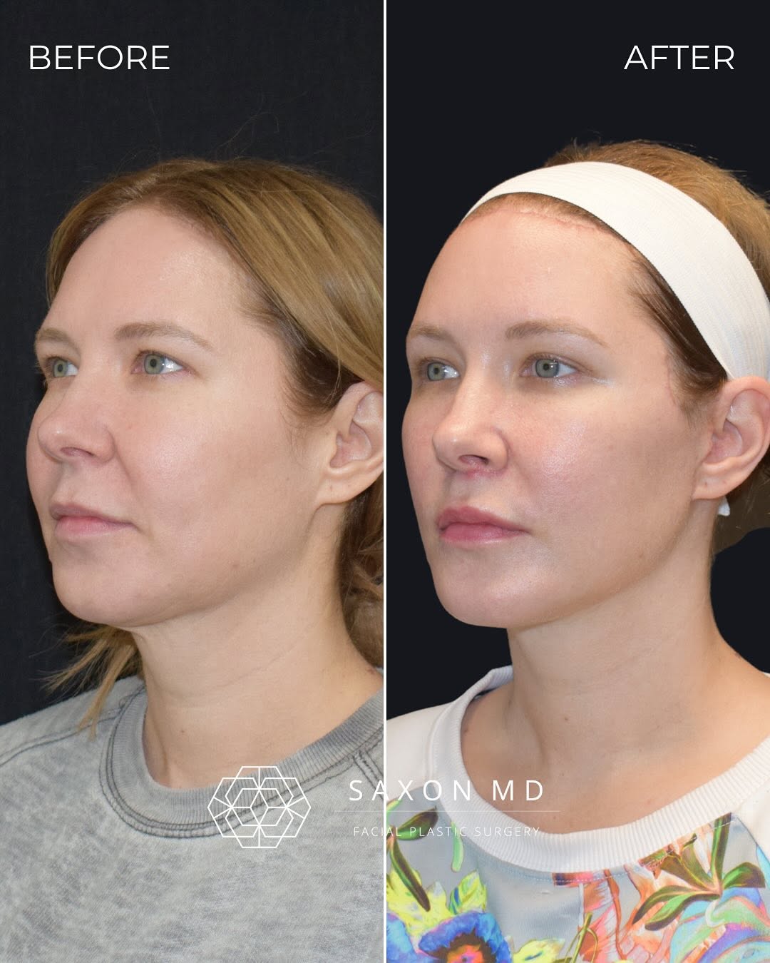 Instagram post by Dr. Sarah Saxon: It’s hard to believe this patient is only one month out from surgery — but the transformation speaks for itself. She underwent a deep plane …