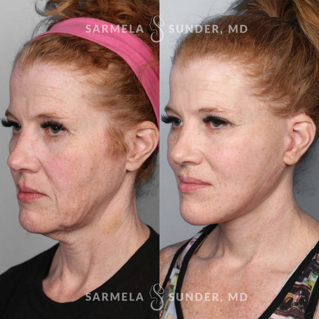 Instagram post by Dr. Sarmela Sunder: Lower Facelift & Necklift • This beautiful patient was concerned with jowling and sagging skin around her neck and jawline. ⠀ My goals when …
