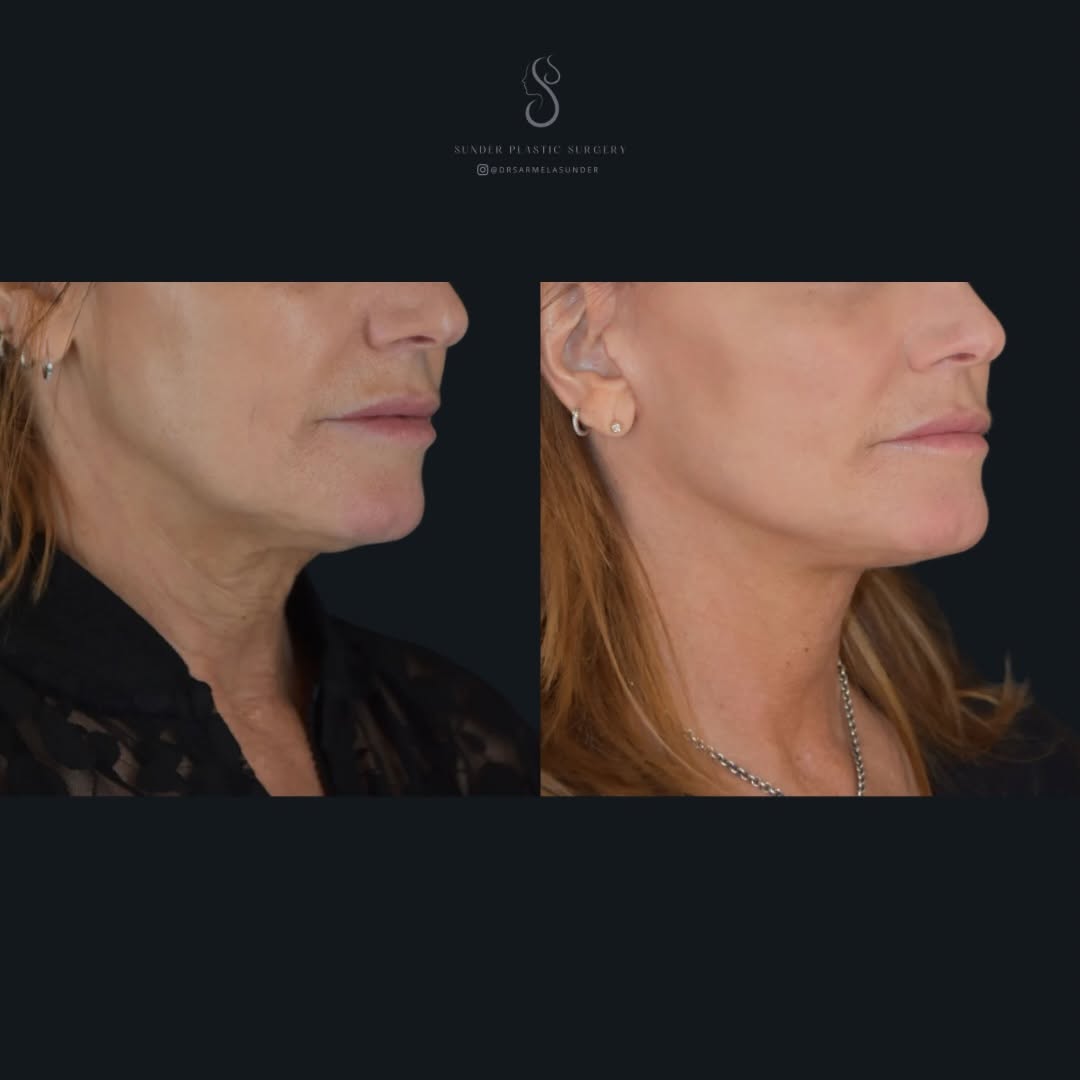 Instagram post by Dr. Sarmela Sunder: My patient came to me feeling unhappy with the way her lower face and neck were changing with age. She wanted improvement, but overall, she …