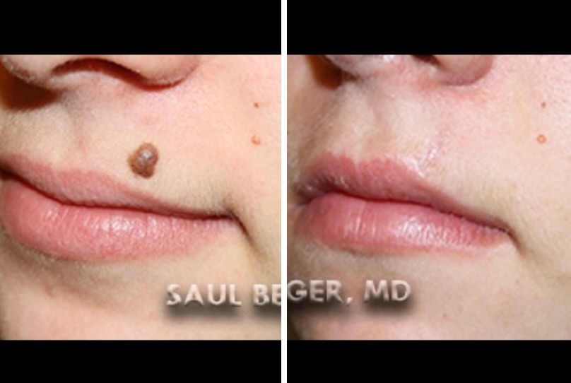 Instagram post by Dr. Saul R. Berger: ✨ Sometimes, a small change can make a BIG difference. This before & after shows the removal of a large mole from the upper lip, with carefu…