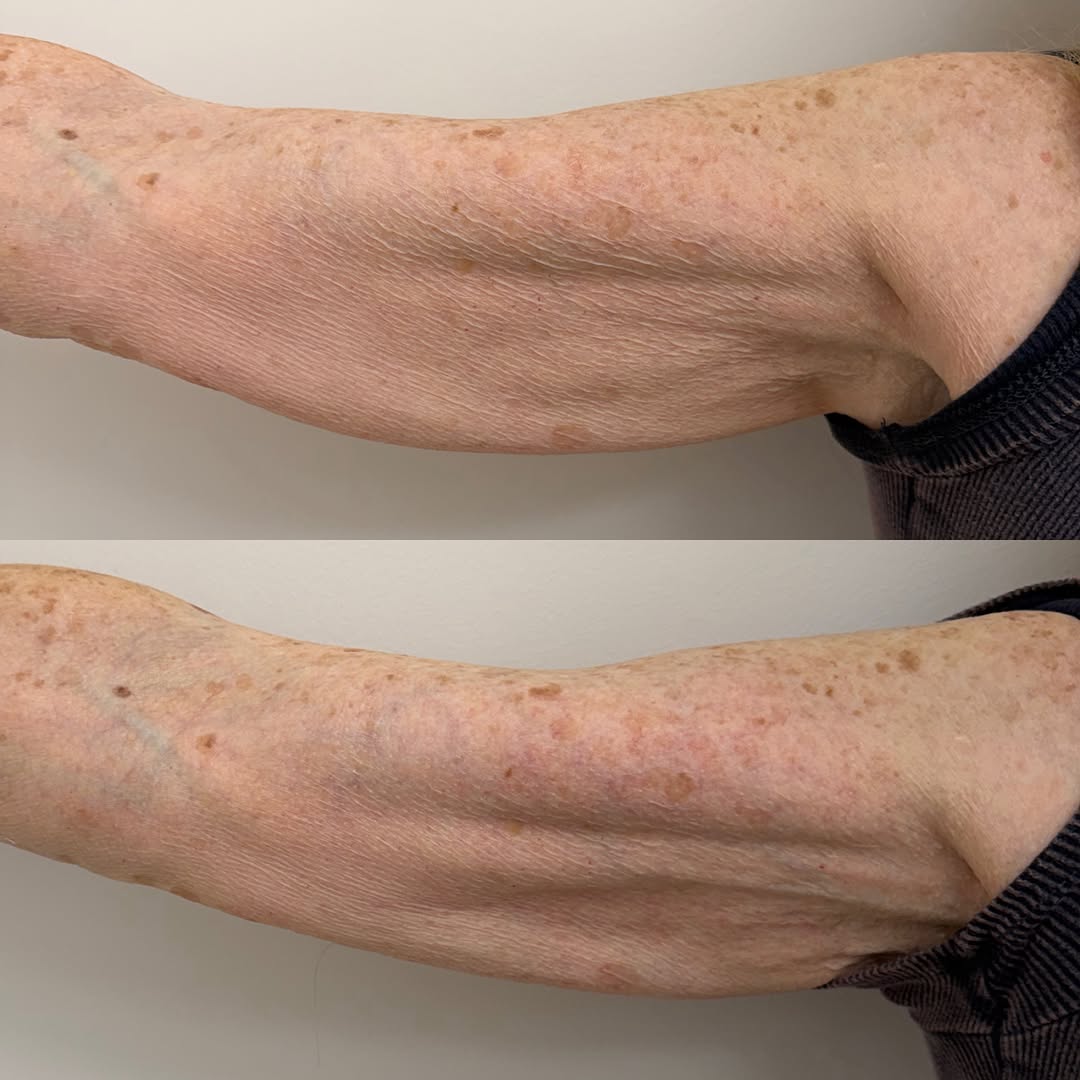 Instagram post by Dr. Scott A. Spiro: • ARM TIGHTENING • A remarkable immediate improvement following XERF skin tightening treatment. XERF uses advanced radiofrequency technology…