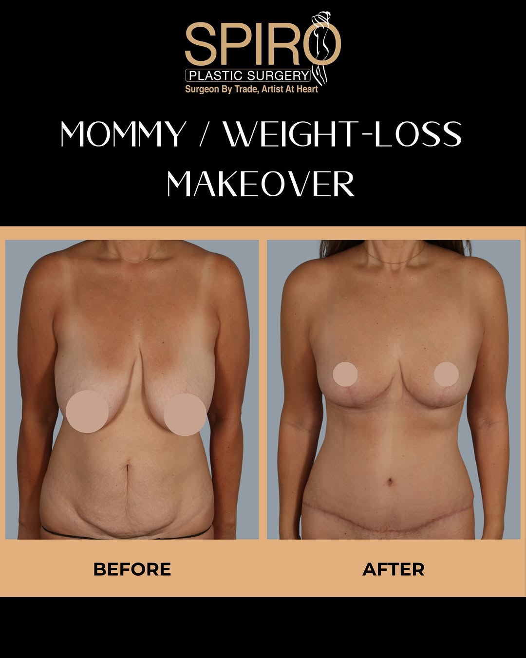 Instagram post by Dr. Scott A. Spiro: A transformation that delivers both aesthetic refinement and functional relief. A bilateral breast reduction was performed to address hypert…