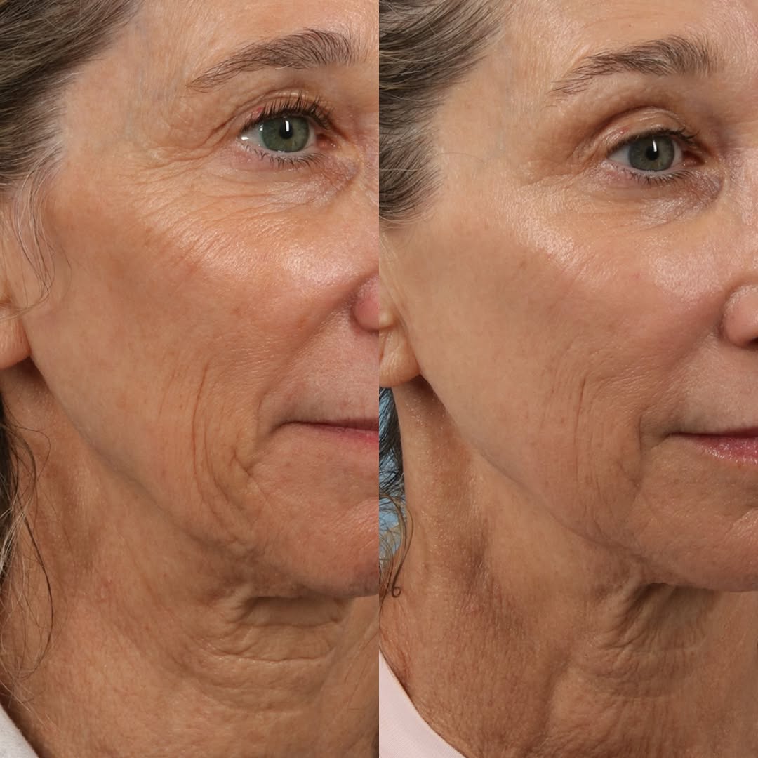 Instagram post by Dr. Scott A. Spiro: • THE POWER OF A TREATMENT PLAN • This transformation is the result of combining Mosaic & Ultra laser treatments, consistent Botox, and medi…