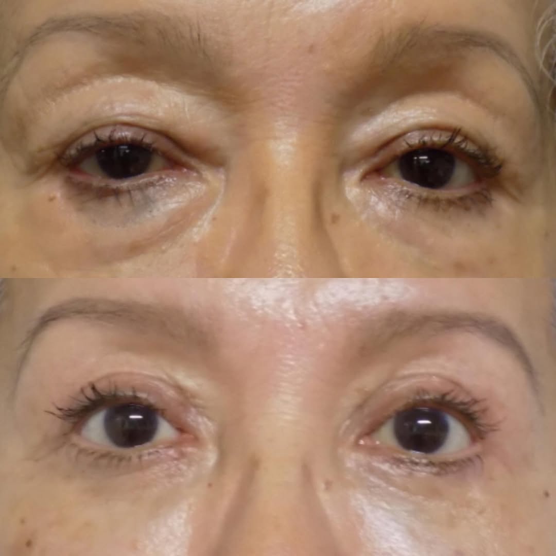 Instagram post by Dr. Scott C. Sessions: Before & After: Quad Blepharoplasty #sessionsplasticsurgery #sessionsplasticsurgerycentre #beforeandafter #beforeandaftersurgery #uppereyeli…