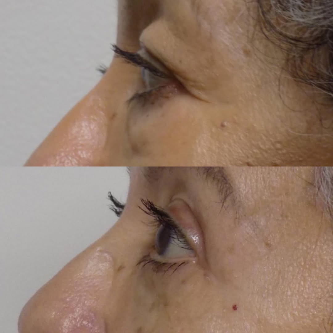 Instagram post by Dr. Scott C. Sessions: Before & After: Quad Blepharoplasty #sessionsplasticsurgery #sessionsplasticsurgerycentre #quadbleph #upperbleph #lowerbleph #upperblepharop…