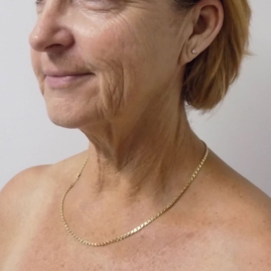 Instagram post by Dr. Scott C. Sessions: Before & After: Face & Neck Lift #sessionsplasticsurgery #sessionsplasticsurgerycentre #faceliftsurgery #neckliftsurgery #beforeandafterface…