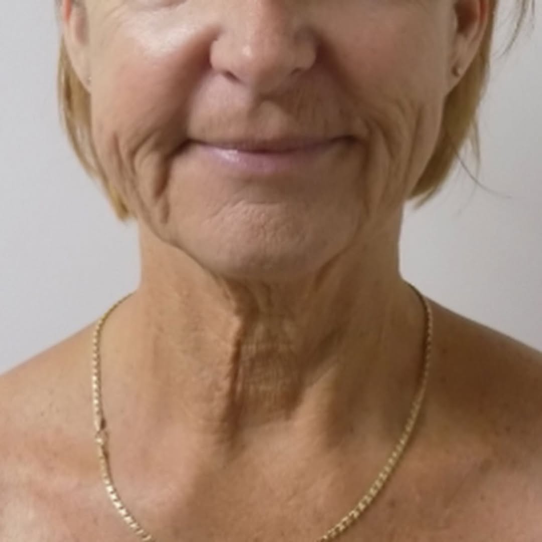Instagram post by Dr. Scott C. Sessions: Before & After: Face & Neck Lift #sessionsplasticsurgery #sessionsplasticsurgerycentre #faceandnecklift #facelift #necklift #beforeandafterf…