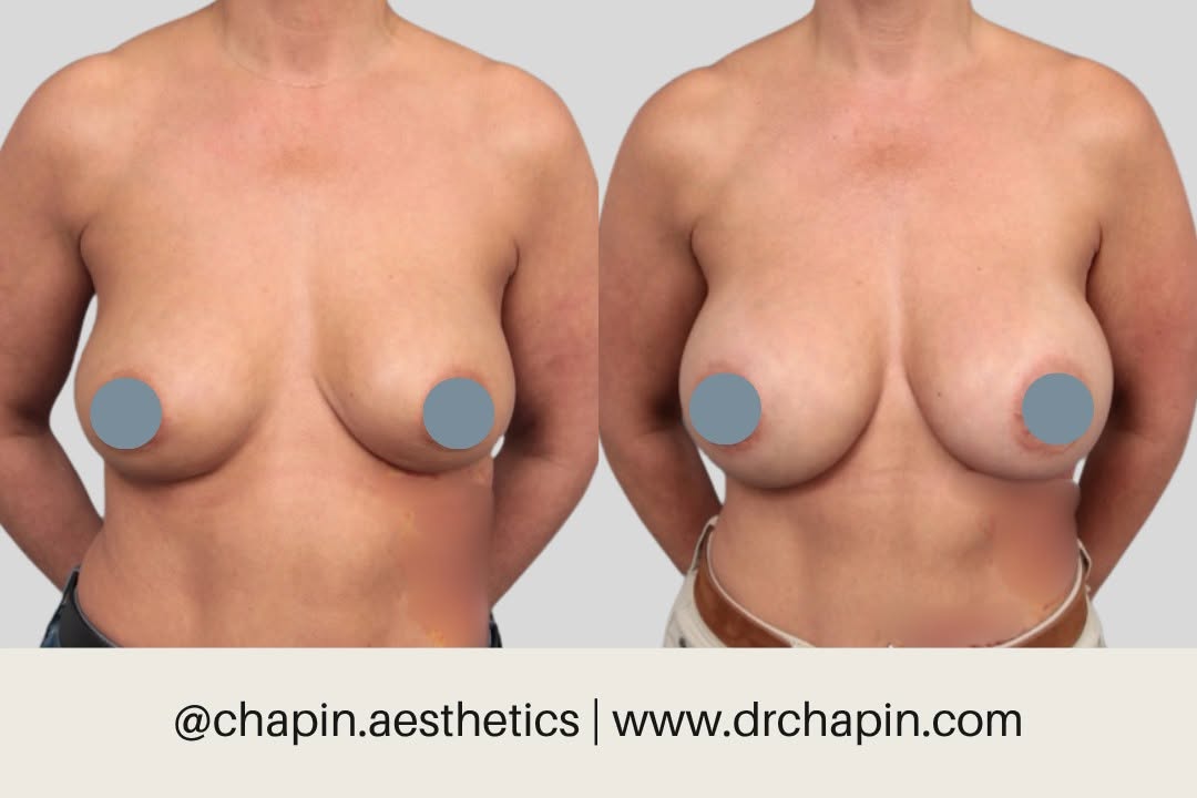 Instagram post by Dr. Scott Chapin: Implant exchange isn't just maintenance. It's an opportunity to get exactly what you want. This 55-year-old patient asked us for increased s…