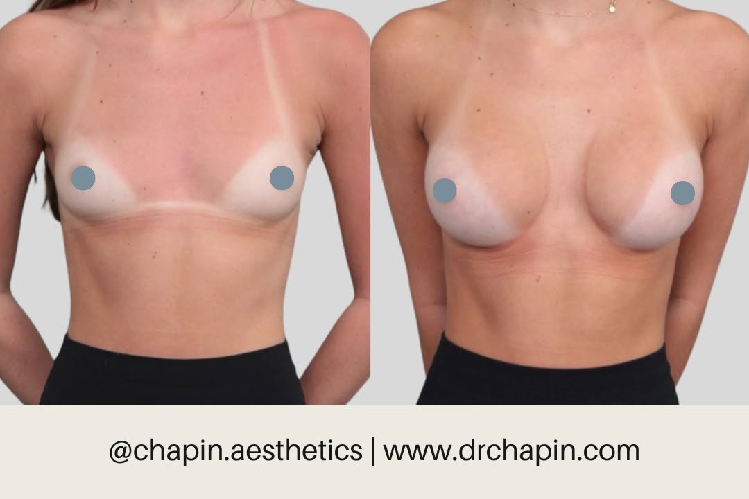 Instagram post by Dr. Scott Chapin: This 21-year-old patient is one month post-op from a breast augmentation with inverted nipple repair by Dr. Chapin. Using 230cc Motiva silic…