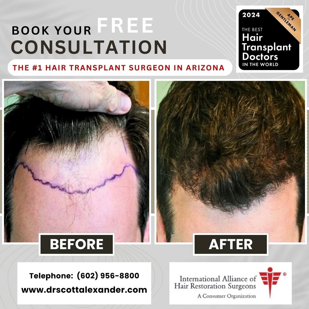 Instagram post by Dr. Scott F. Alexander: Voted one of the very best hair transplant surgeons in the world and part of the prestigious IAHRS. If you are dealing with hair loss and re…