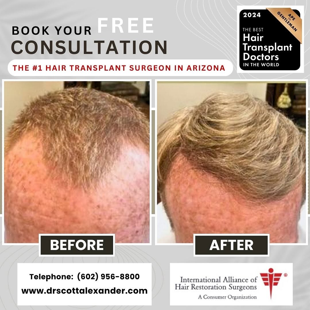Instagram post by Dr. Scott F. Alexander: 3114FU with Dr Scott Alexander in Arizona. Voted one of the very best hair transplant surgeons in the world and part of the prestigious IAHR…