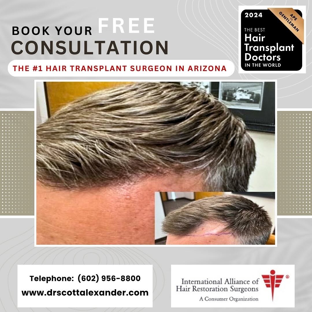Instagram post by Dr. Scott F. Alexander: 2185 FU with Dr Scott Alexander in Arizona. Voted one of the very best hair transplant surgeons in the world and part of the prestigious IAH…