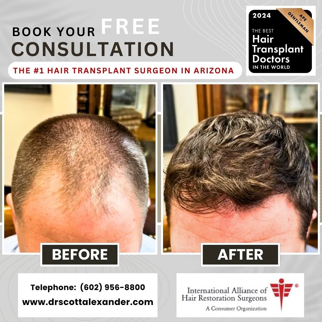 Instagram post by Dr. Scott F. Alexander: 1 year post op 2023 FU via FUE with Dr Scott Alexander. surgeons in the world and part of the prestigious IAHRS. If you are dealing with hai…