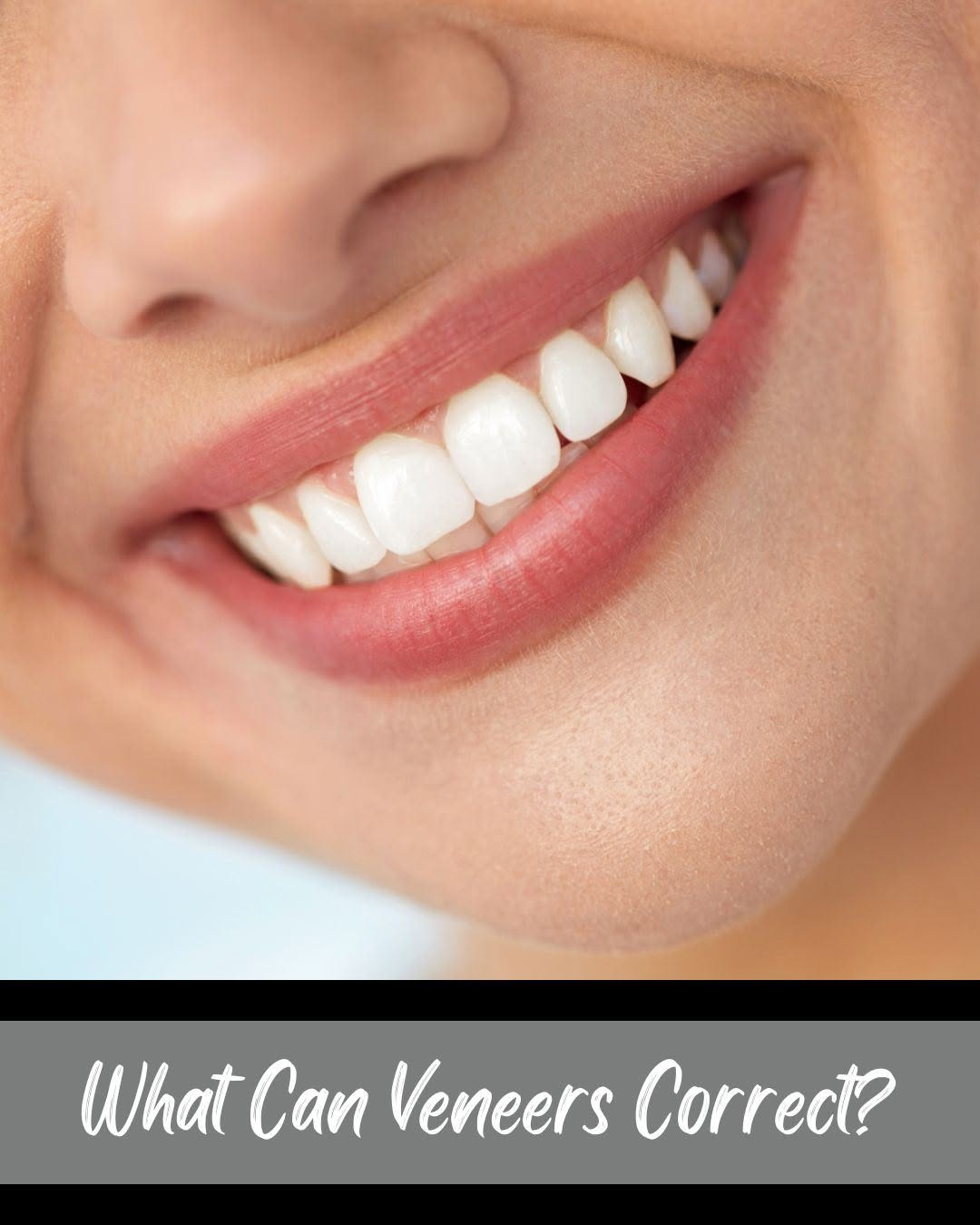 Instagram post by Dr. Scott Greenhalgh, DDS: Dental veneers are a conservative way to improve the shape, color, and balance of a smile while preserving as much natural tooth structure a…