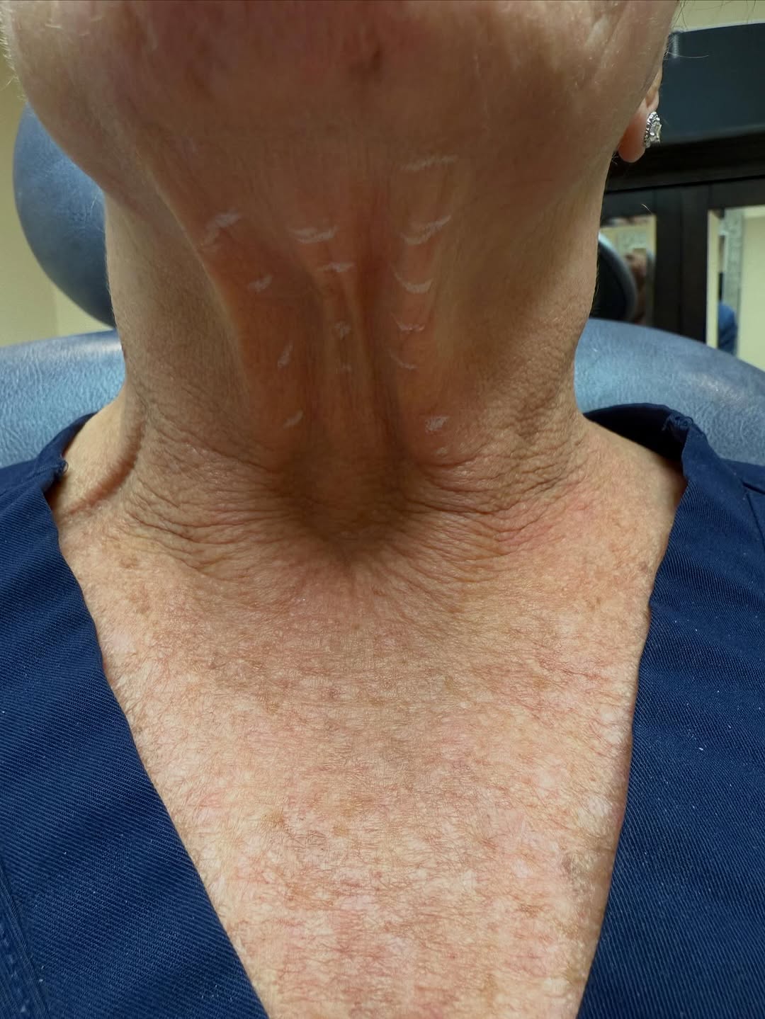 Instagram post by Dr. Scott Hernberg, DO: Turkey 🦃 Neck gotcha Gobbling??? Now offering: Ultherapy Neck treatment $2300, plus get a years worth of botox for the platysmal bands (ver…