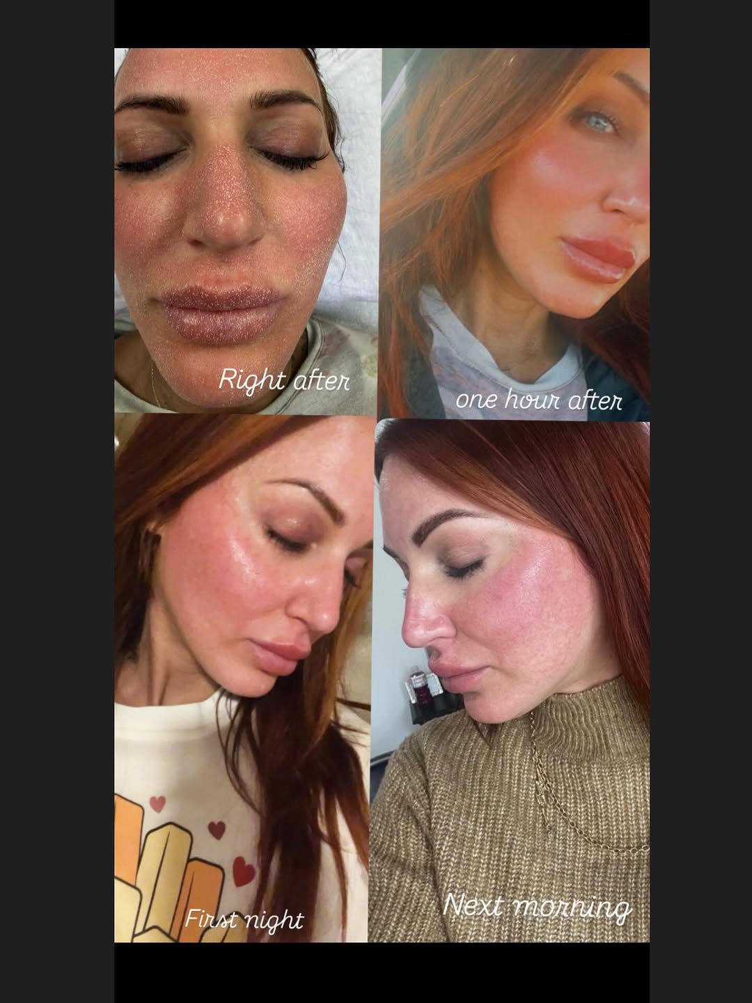 Instagram post by Dr. Scott Hernberg, DO: A Journey of Dr. Hernberg’s meticulous blend of science and artistry to skin rejuvenation through the combined power of the Lumenis IPL/Phot…