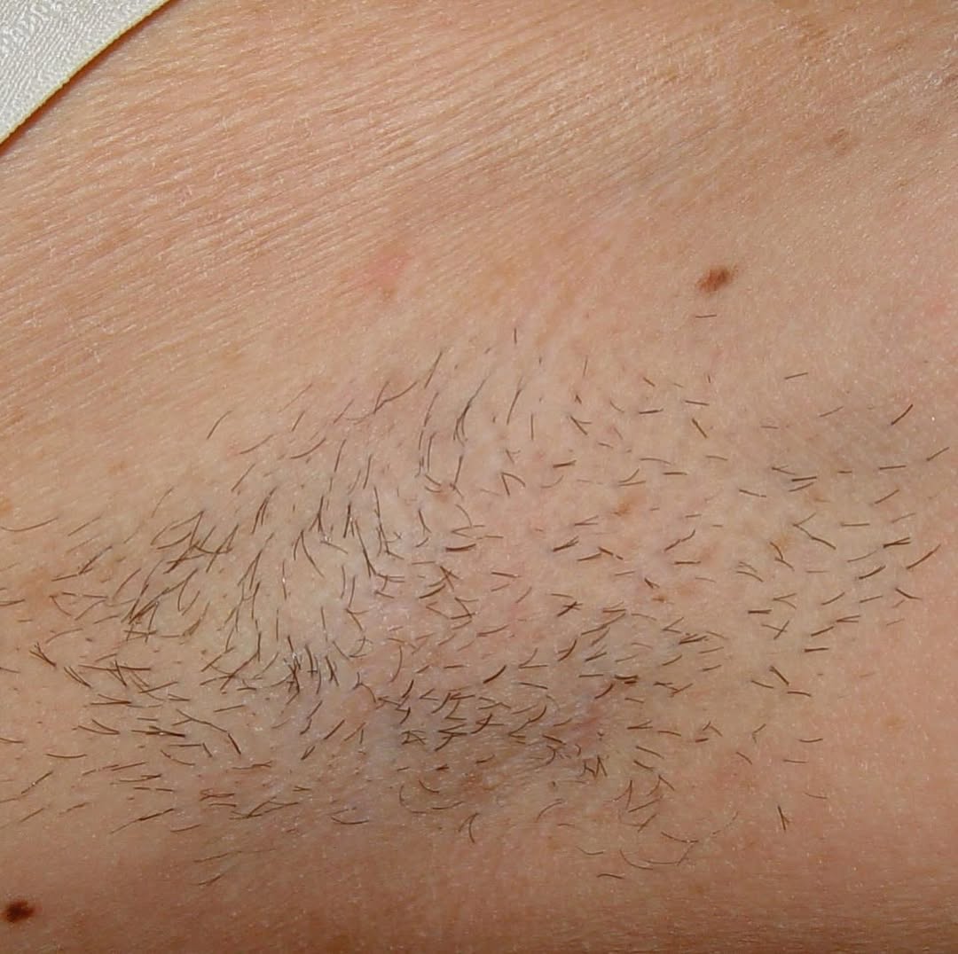 Instagram post by Dr. Scott Hernberg, DO: Laser Hair Removal by Dr. Hernberg! The SplendorX laser hair machine by Lumenis combines Alexandrite and Nd:YAG wavelengths for a perfectly …