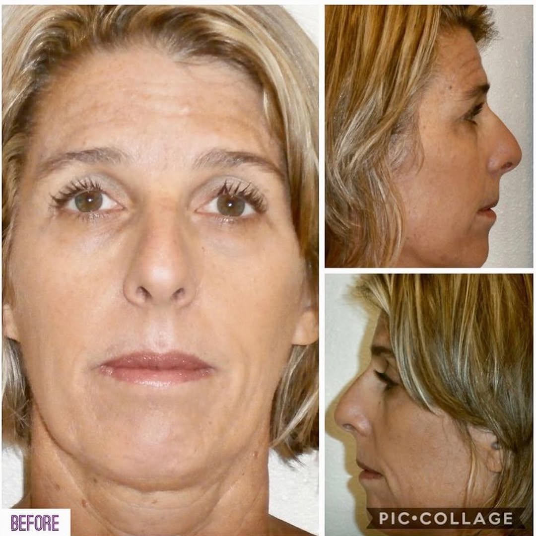 Instagram post by Dr. Scott Loessin: SWIPE ➡️ to see the after👏🏼 We love these Rhinoplasty results by Dr. Loessin! Book your FREE consultation today! 📞(305) 809.8011 …