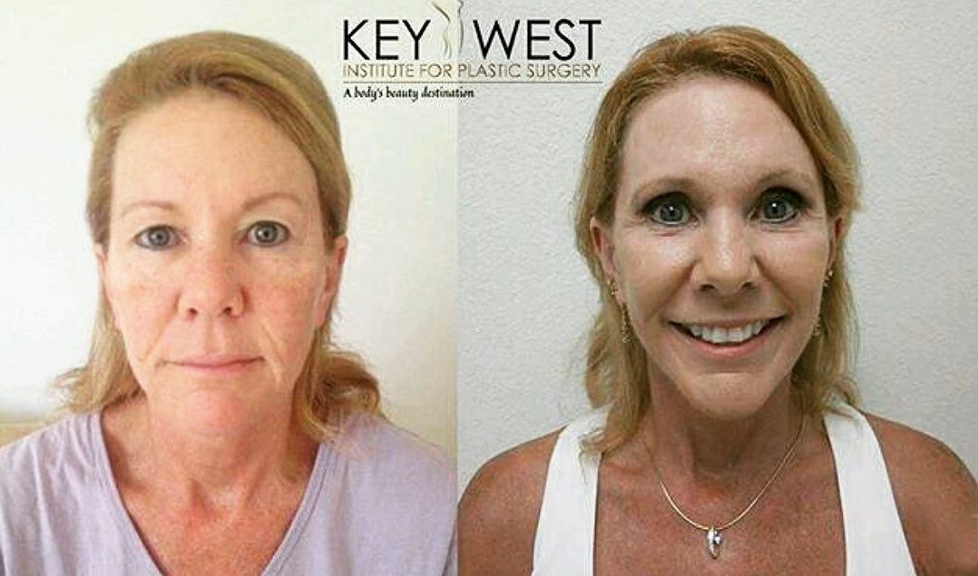 Instagram post by Dr. Scott Loessin: CO2 Fractional Laser Resurfacing removes layers of skin tissue in a fractionated method (columns of skin are removed, leaving the skin surro…