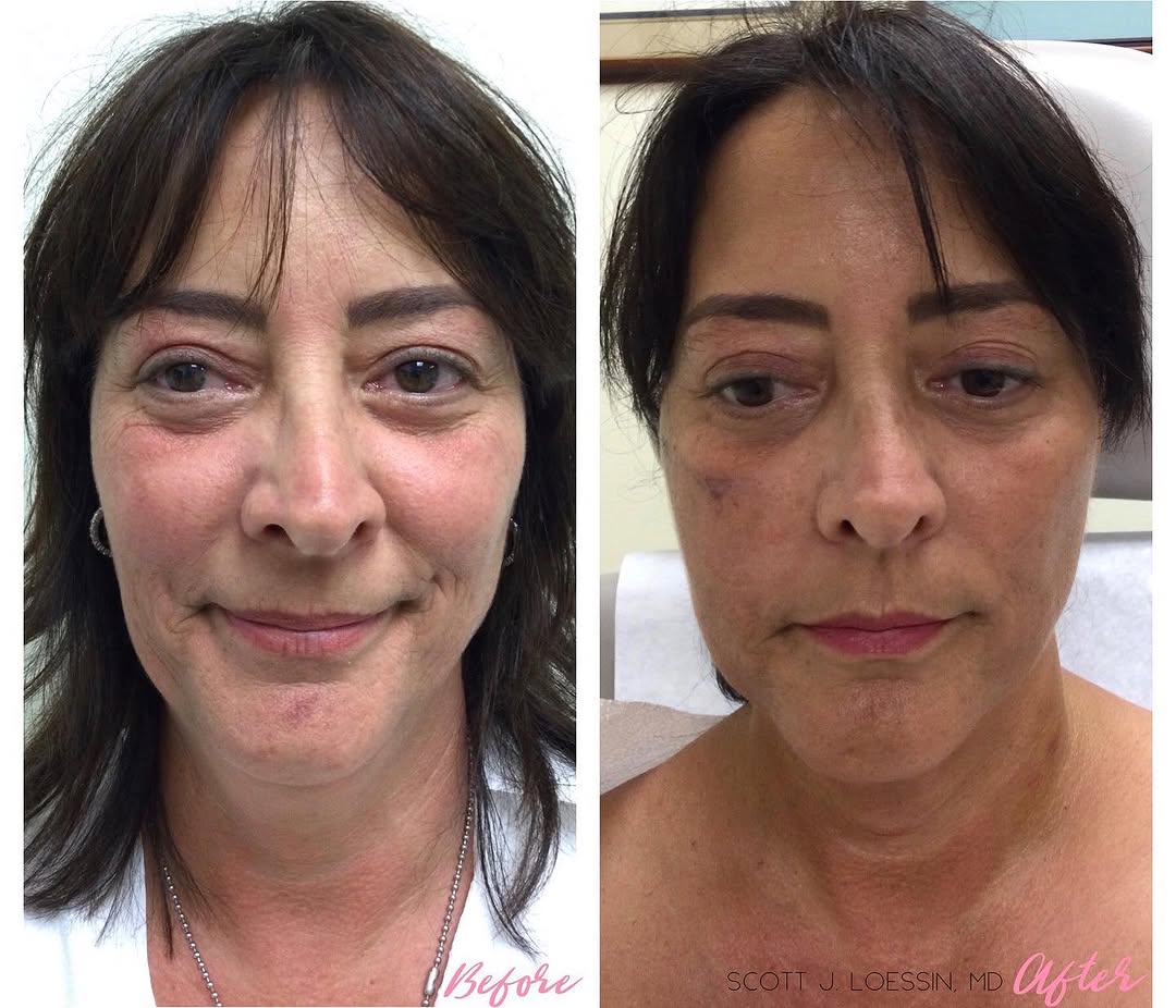 Instagram post by Dr. Scott Loessin: Talk about a transformation by Dr. Loessin! This patient is just 1 week post Facelift with Fat Transfer and is looking YEARS younger!😱😍 Ca…