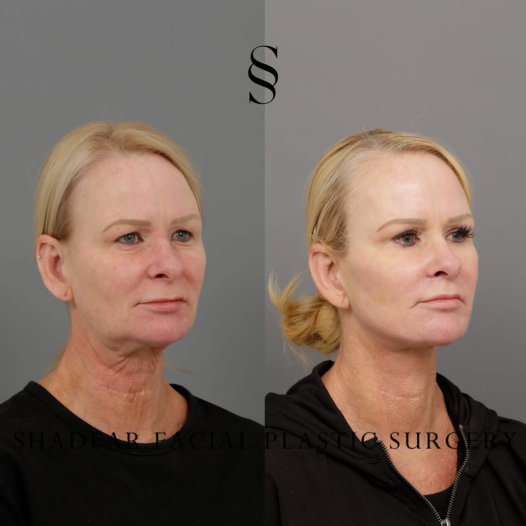 Instagram post by Dr. Scott Shadfar: Following up on our recent video reveal, we are sharing these direct side-by-side images to give you the time to truly study the detail-orie…
