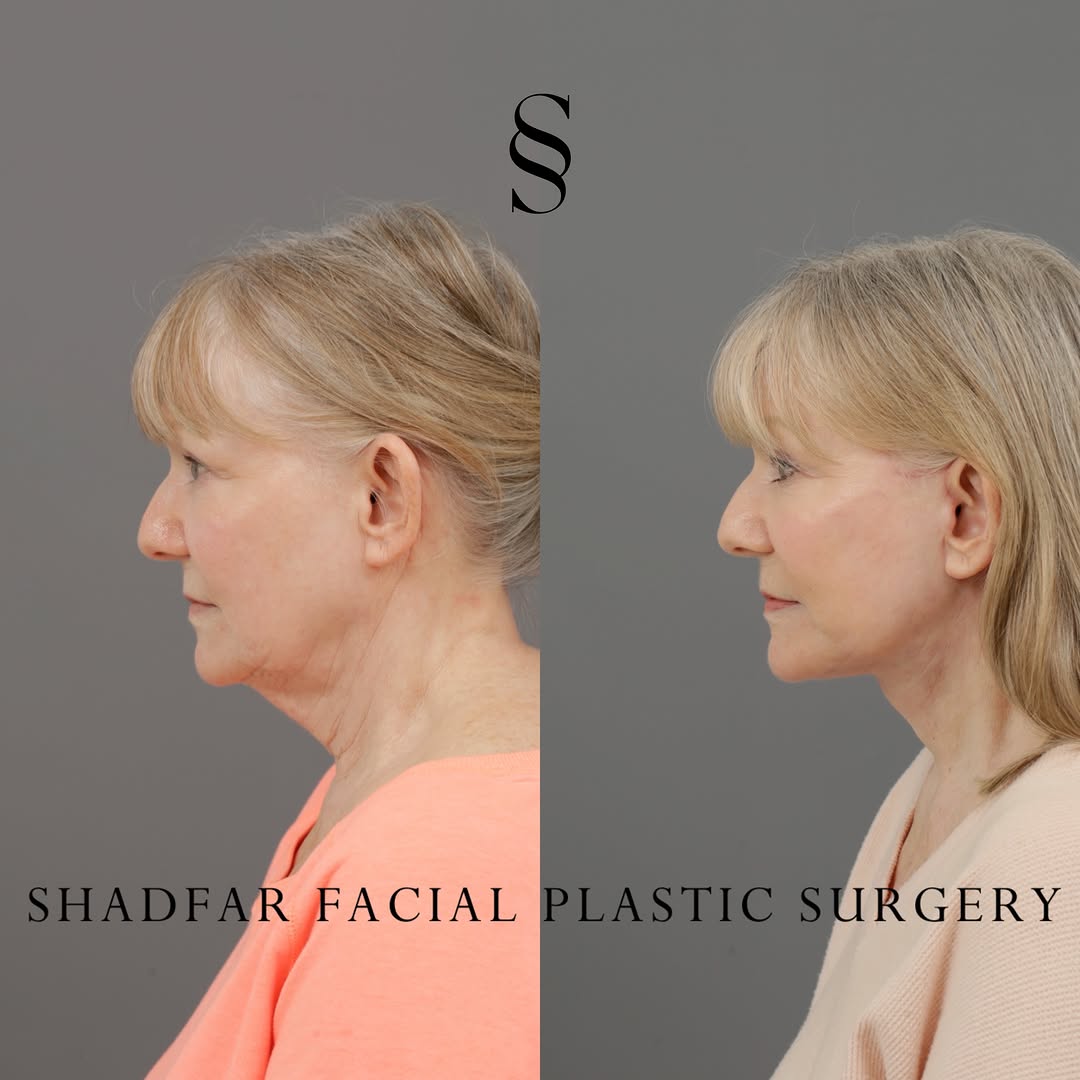 Instagram post by Dr. Scott Shadfar: Following up on our video reveal from Friday, we are sharing these direct side-by-side still images so you can take your time to truly study…