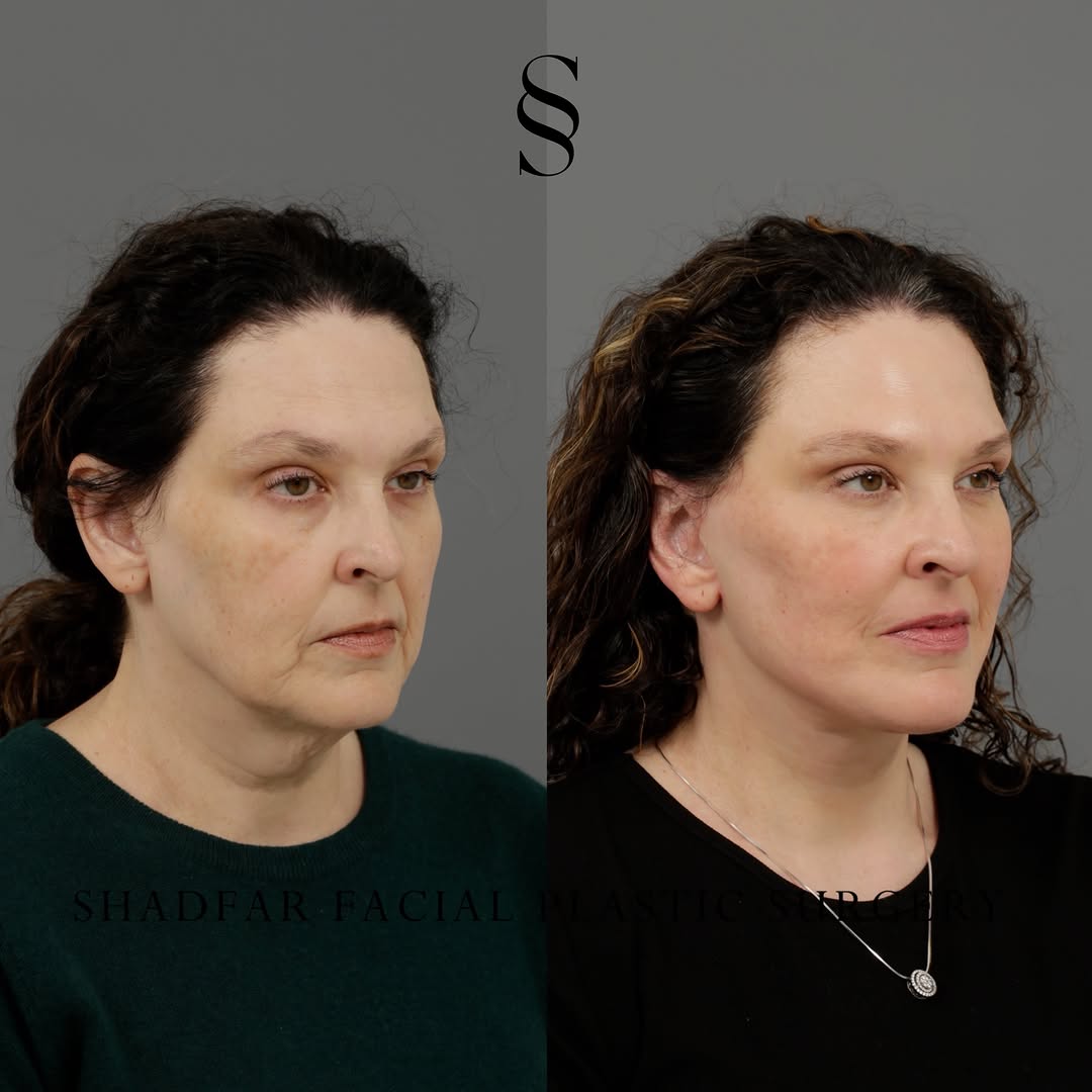 Instagram post by Dr. Scott Shadfar: Following up on our recent video reveal, we are sharing these direct side-by-side images so you can take your time analyzing both the macro …